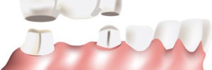 bad breath and dental bridges
