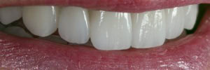 E Max Crowns that look like real teeth