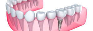 Best Way to Replace Teeth
