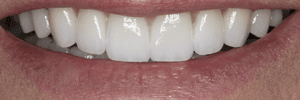 Improve my smile