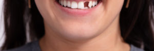restore your smile incomplete smile
