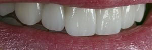 Change the shape of teeth