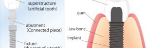 patient with Hypodontia
