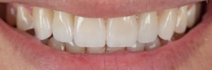 Implant planning