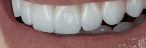 Will veneers ruin my teeth