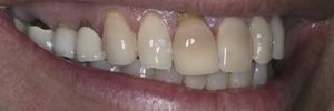 gum recession