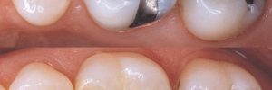 Tooth fillings