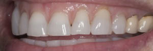 Heavy tooth wear