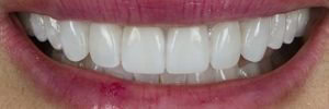 POM crowns
