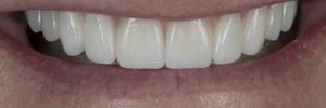 Zirconium crowns