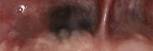 Amalgam tattoo