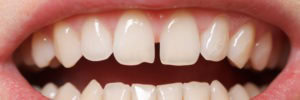 Diastema