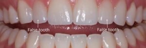 cleaning dental bridges