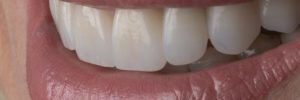 What are veneers