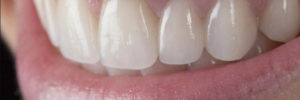 tooth bridge
