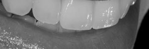 Do veneers make your breath smell