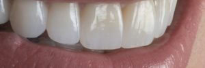 Front tooth enhancements