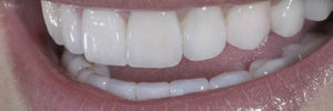 full mouth reconstruction