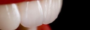 porcelain crowns