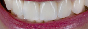 best crowns for teeth