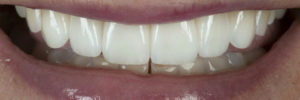 Cosmetic veneers