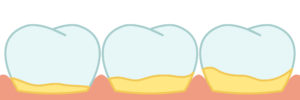 Plaque vs Tartar