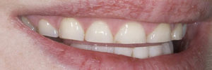 short teeth