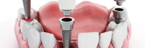 dental model showing implants and crowns