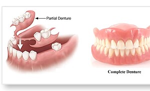 Partial-Denture-and-Complete-Denture.jpg