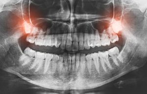 Why take out wisdom teeth?