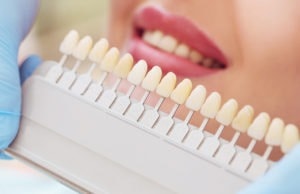 crown vs veneer