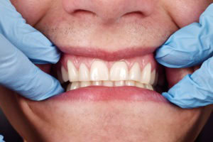 receding gums