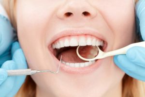 developing cavities