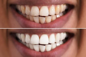 discolored teeth