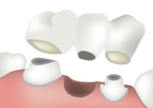 How long does a tooth bridge last