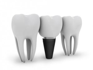 dental implants