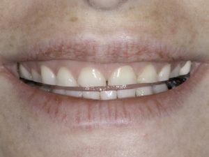 results of bruxism is tooth wear