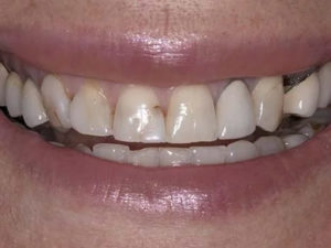 Dental health changes with age