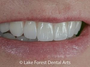 Prepless veneers