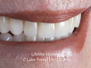 Lifelike crowns