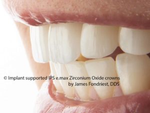 Implant crowns