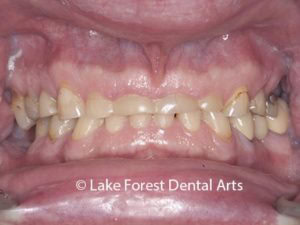 what is bruxism