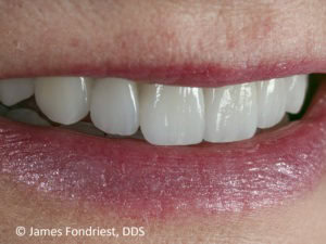 E Max Crowns that look like real teeth