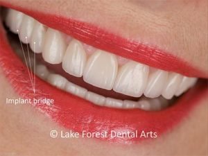Implant bridge
