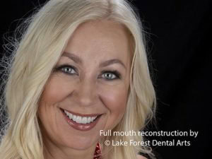 Full Mouth Rehabilitation