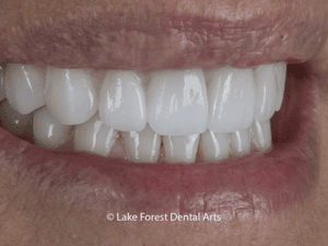 Caring for dental porcelain