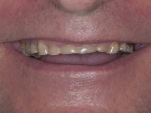 patient with bruxism