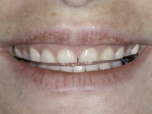 Constantly Grind Your Teeth