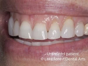 Excess gum tissue
