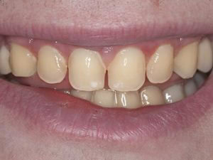 Lost tooth enamel from enamel erosion